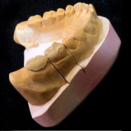 Prótesis Dental Dentic molde para prótesis