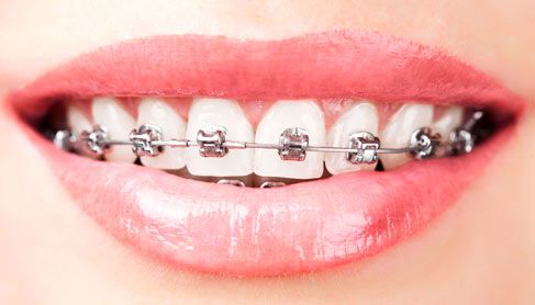 Prótesis Dental Dentic brackets
