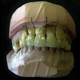 Prótesis Dental Dentic molde de prótesis