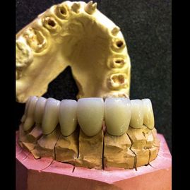 Prótesis Dental Dentic prótesis de dientes inferiores