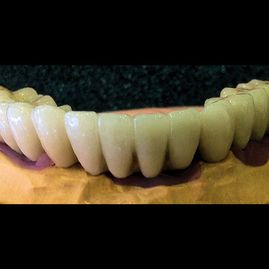 Prótesis Dental Dentic dientes inferiores