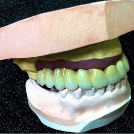 Prótesis Dental Dentic molde