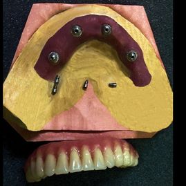 Prótesis Dental Dentic tornillos