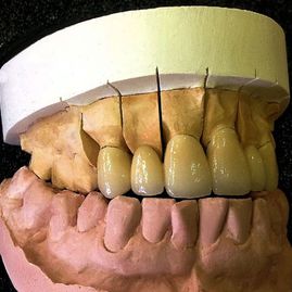 Prótesis Dental Dentic molde para realizar prótesis