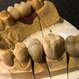 Prótesis Dental Dentic muelas